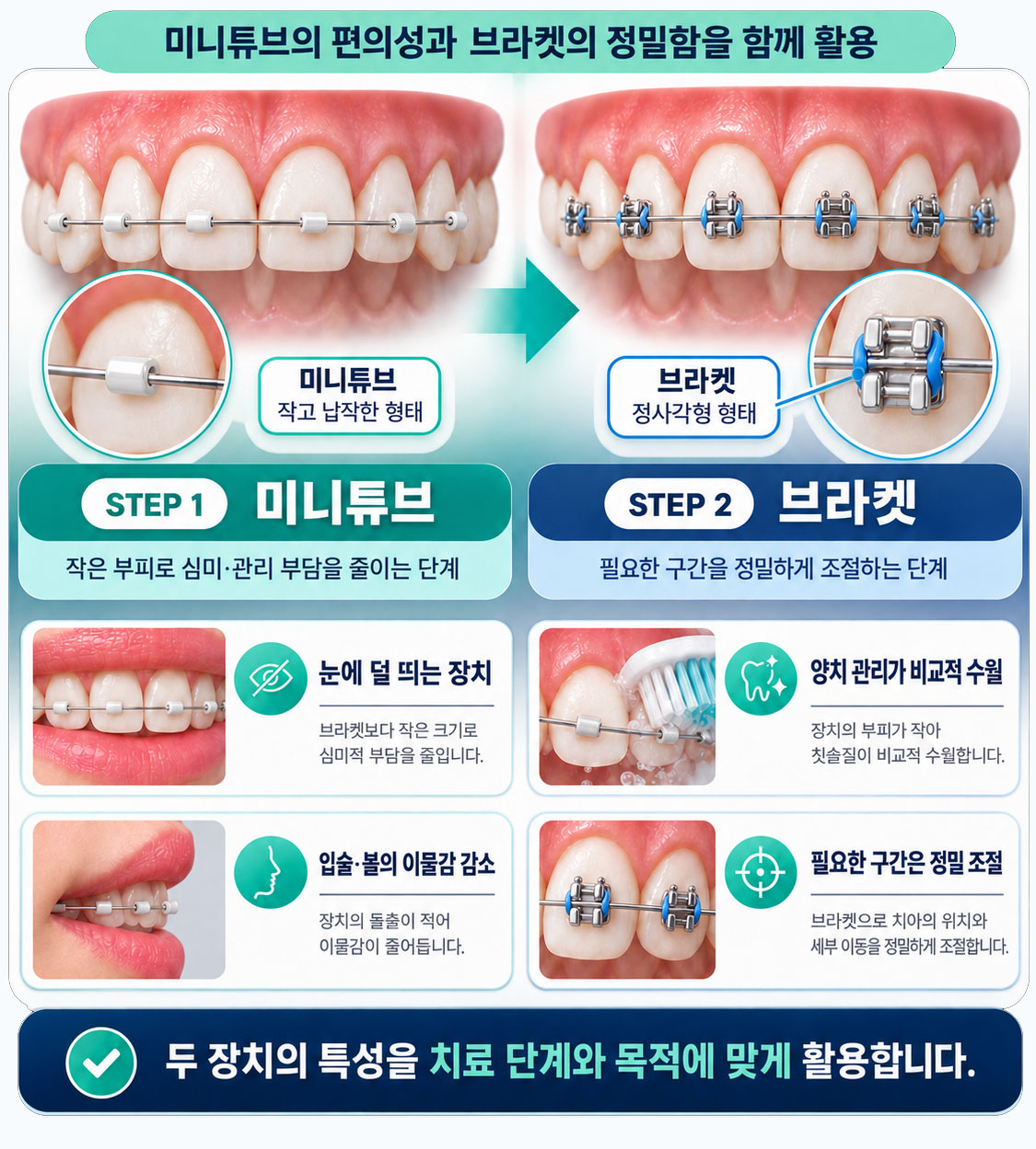 인천논현역 투스텝 교정 미니튜브 브라켓 결합 장치 설명