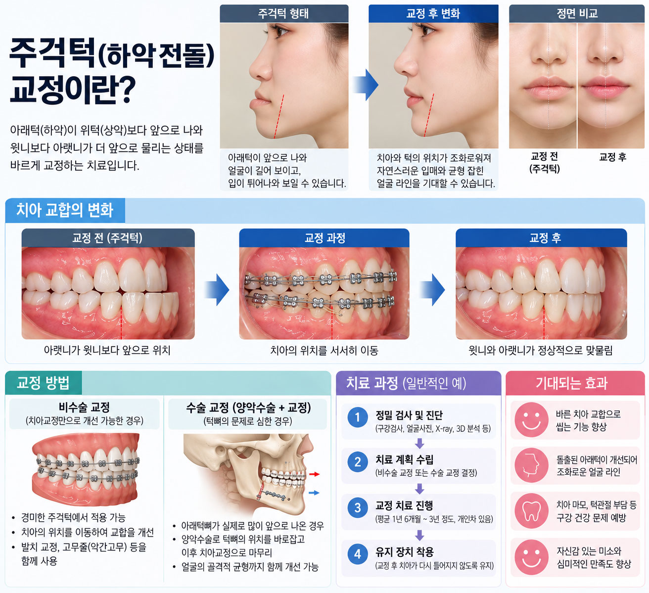 인천논현역 주걱턱 교정 아래턱 전돌 반대교합 3급 부정교합 설명
