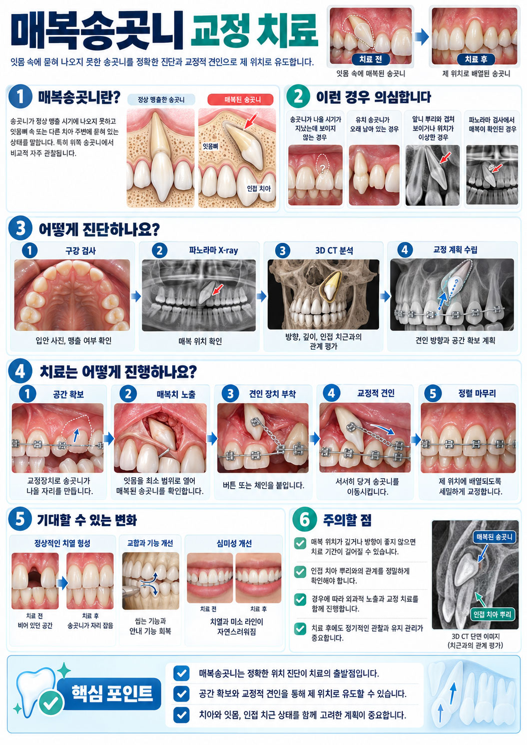 인천논현역 매복치아 교정 매복 송곳니 교정적 견인 설명
